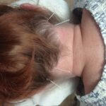Igłoterapia mięśni podpotylicznych