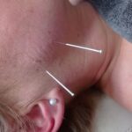 Suche igłowanie żwaczów